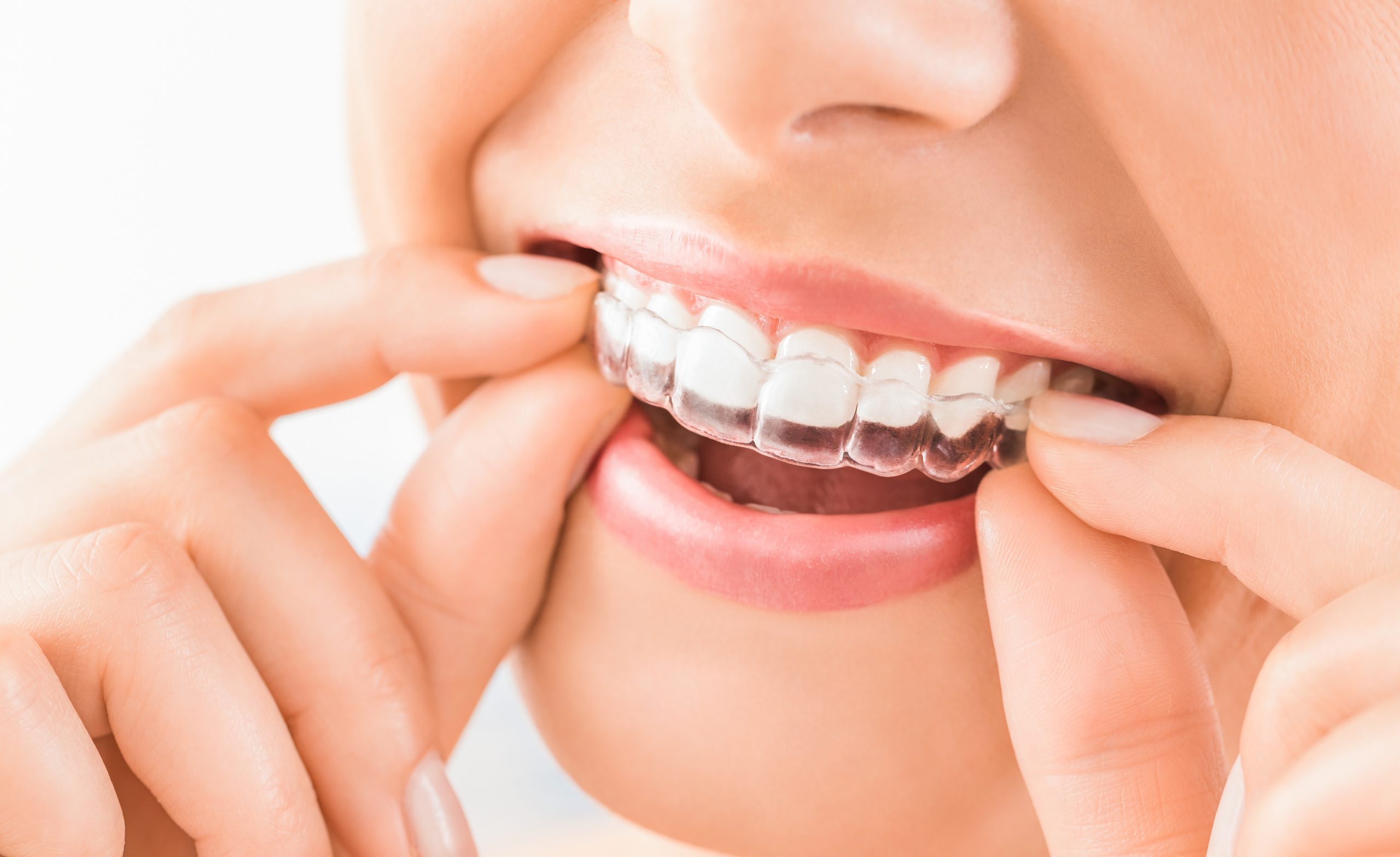 Teeth Discolouration & Whitening