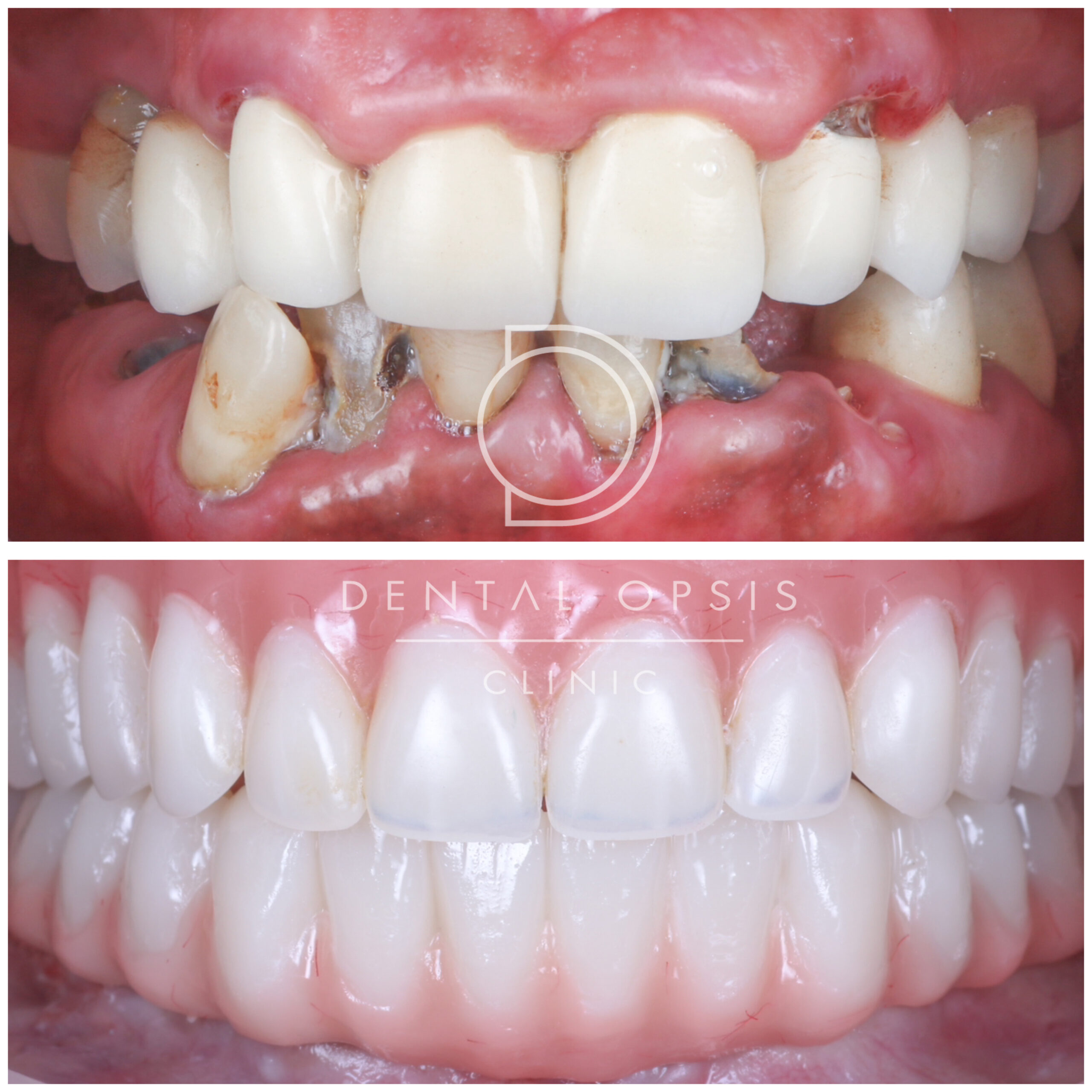 Case with Implants / Full Mouth Reconstruction