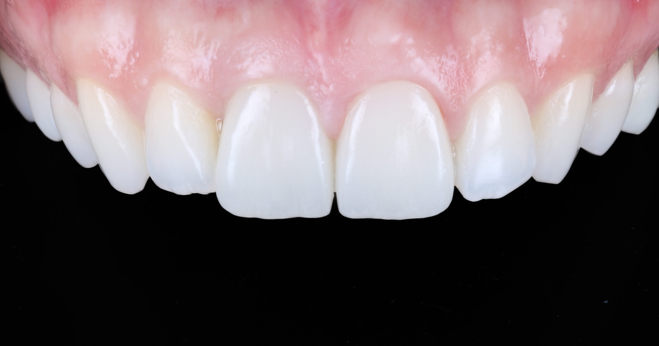 Porcelain Veneer And Implant Crown In The Esthetic Area