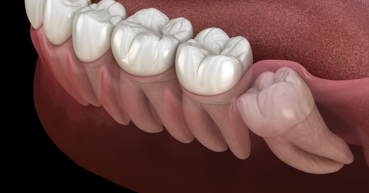 Wisdom Teeth – Pain Management