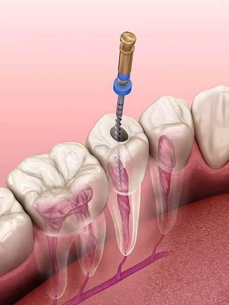 How the Endodontic Treatment is Done