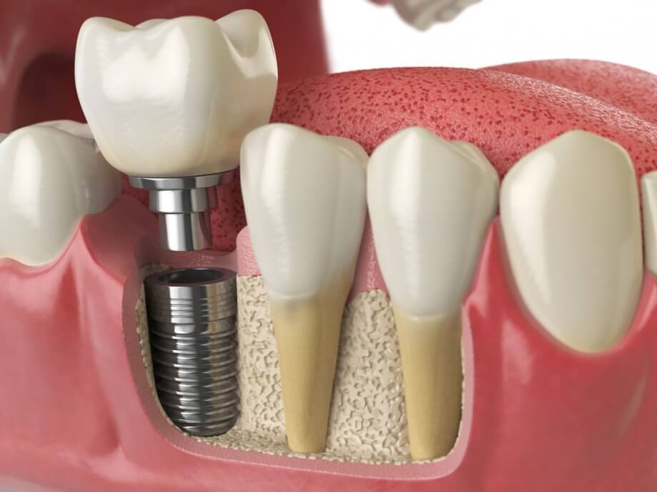 Extraction , Implant & Provisional in One Appointment