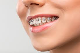 How to clean my teeth with braces