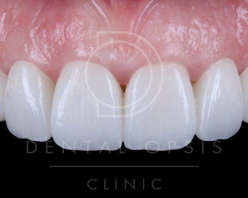 Design Teacth Correction