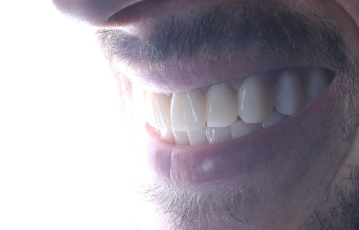 final result of teeth whitening