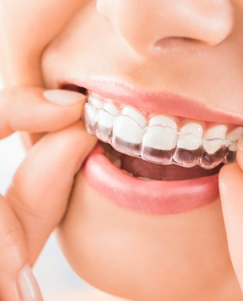clear aligners on